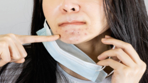Maskne: Arizona dermatologist shared tips to prevent acne under mask