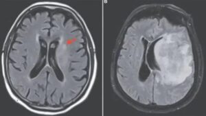 Rare Infection From Garden Soil Makes Man’s Brain Turn Into ‘Liquid’, Dies!