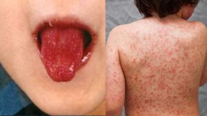 Kawasaki Like Disease Linked To COVID-19 Can Kill Children And Adults