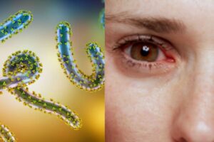 What is Bleeding Eye Virus? Travel Warnings Issued Amid Health Fears